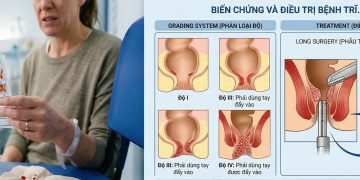 Cảnh báo: Suýt mất mạng vì chủ quan với bệnh trĩ, phải truyền 6 đơn vị máu cấp cứu
