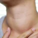 Ung Thư Tuyến Giáp: Nhận Diện Sớm Dấu Hiệu Để Điều Trị Hiệu Quả