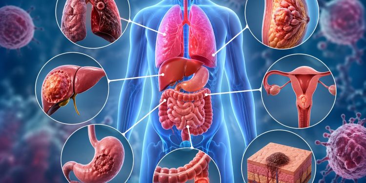 Những bộ phận nào trên cơ thể thường gây ung thư? Cảnh báo sớm để phòng tránh hiệu quả