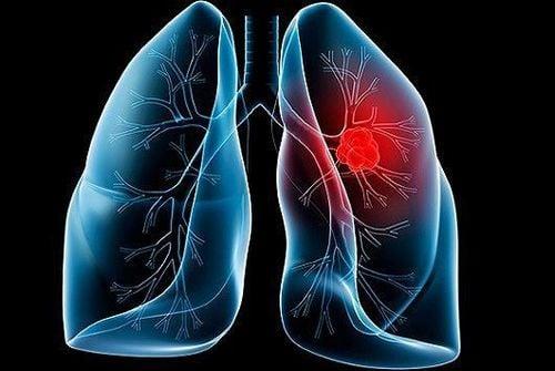 Những bộ phận nào trên cơ thể thường gây ung thư? Cảnh báo sớm để phòng tránh hiệu quả